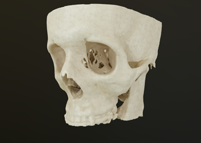 Partial Cranium – 3D Computerized Tomography